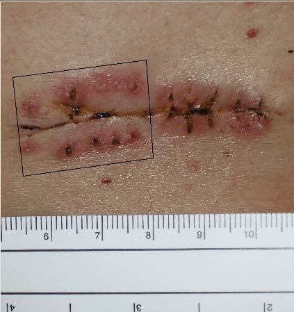 infected c section scar