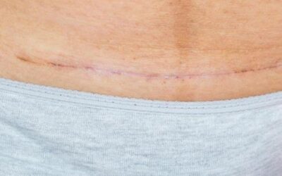 Can You Treat Old Scars? Why It’s Never Too Late for Scar Therapy