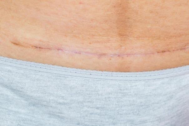 Atrophic - Flat Line Scar