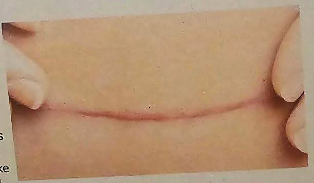 Hypertrophic scar
