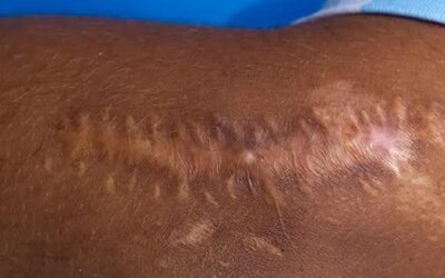 Caring for Your Scar After a C-Section – Consider Postnatal Scar Therapy in Paignton