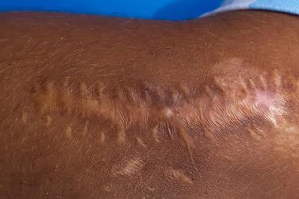 Caesarean section (C-section) scar caused by operation to deliver a baby through a cut made in female tummy skin and womb