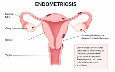 Can Physiotherapy Help With Managing Endometriosis? A Guide for Women in Paignton